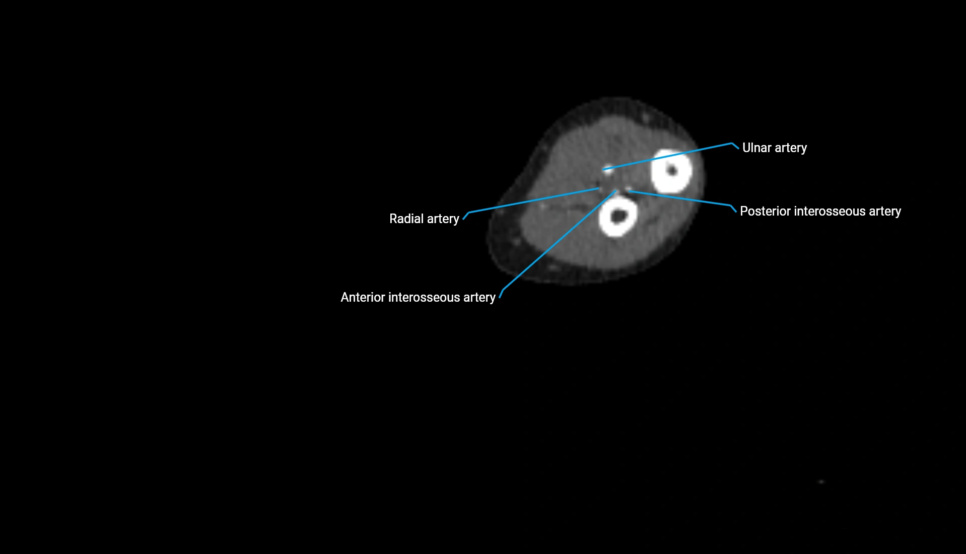 CTA upper limb axial cross sectional anatomy labelled image 162 (2).webp